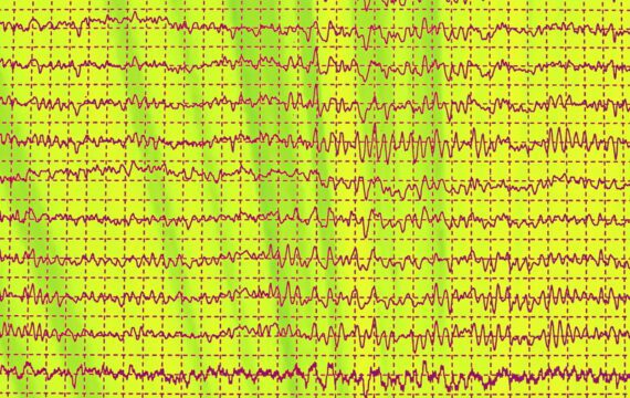 App detecteert epilepsieaanval bij kinderen