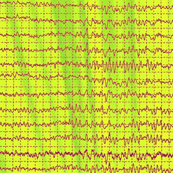 App detecteert epilepsieaanval bij kinderen