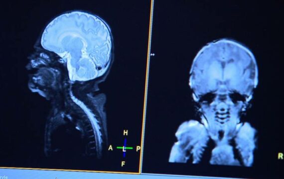 MRI-scan baby geeft pasgeborenen betere toekomst