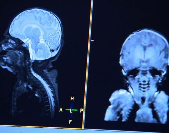 MRI-scan baby geeft pasgeborenen betere toekomst