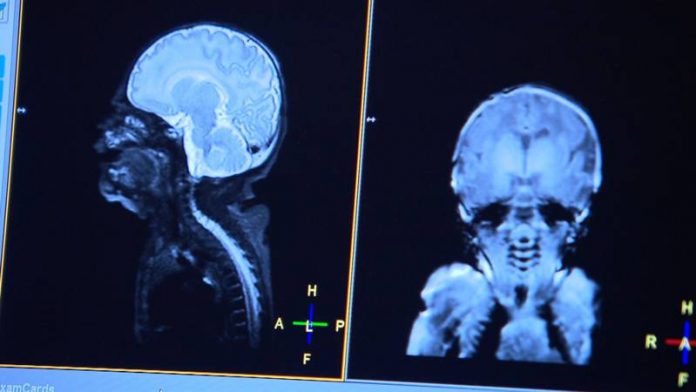 babyhersenen Scan babyhersenen