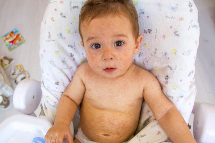 allergie baby met uitslag door allergische reactie