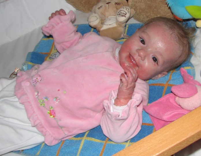 allergie baby met koemelkallergie