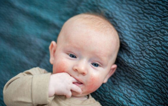 Neem voedselallergie van jonge kinderen serieus