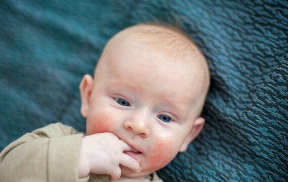 Algoritme stelt allergie vast bij kinderen