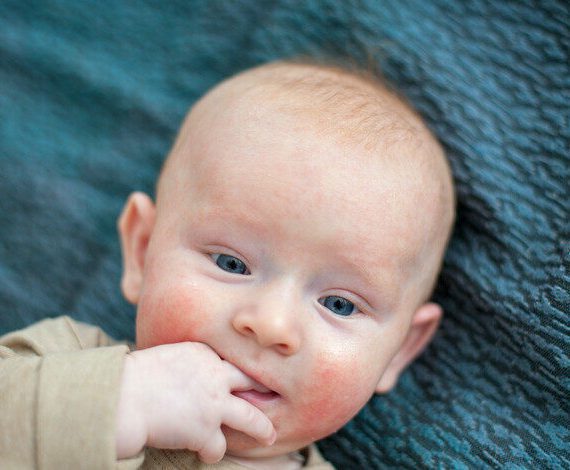 Algoritme stelt allergie vast bij kinderen